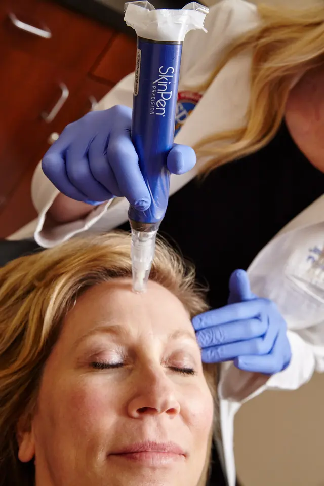 SkinPen microneedling treatment close-up
