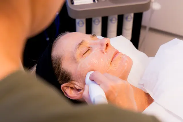 Tailored radiofrequency skin tightening treatment in progress