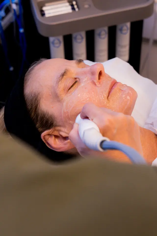 Radiofrequency skin tightening treatment being performed on the face