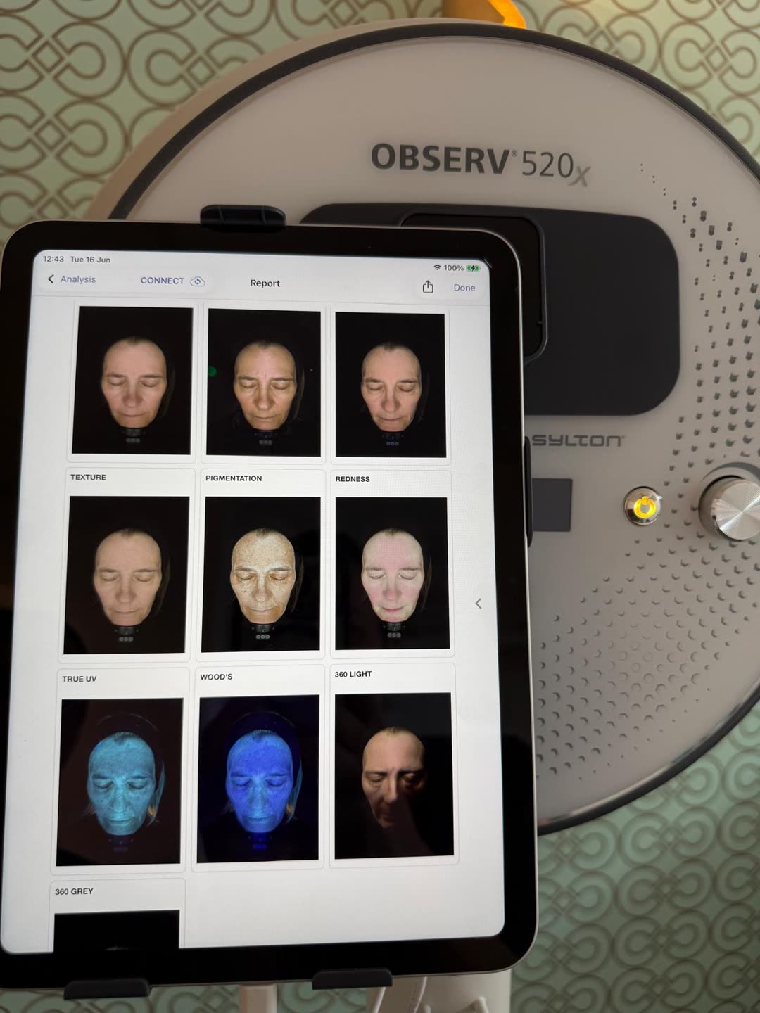 An OBSERV 520x skin report showing texture, pigmentation, redness, true UV and Wood's light views of a face