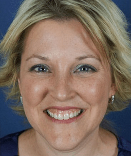 Gummy Smile Before Treatment